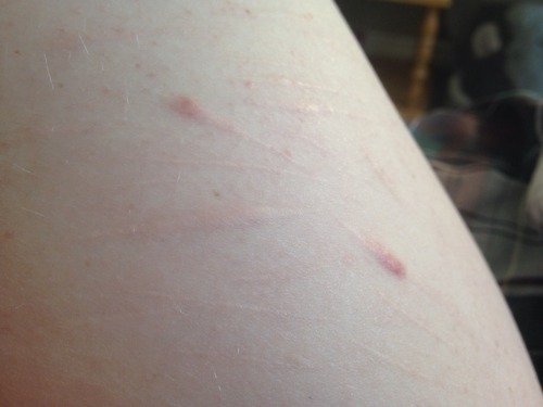lilspirit:  freckles, scars, fat, body hairThings that are not wrong with my body