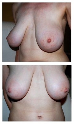 ourbreasts:  Anonymous Submission: Hi. I