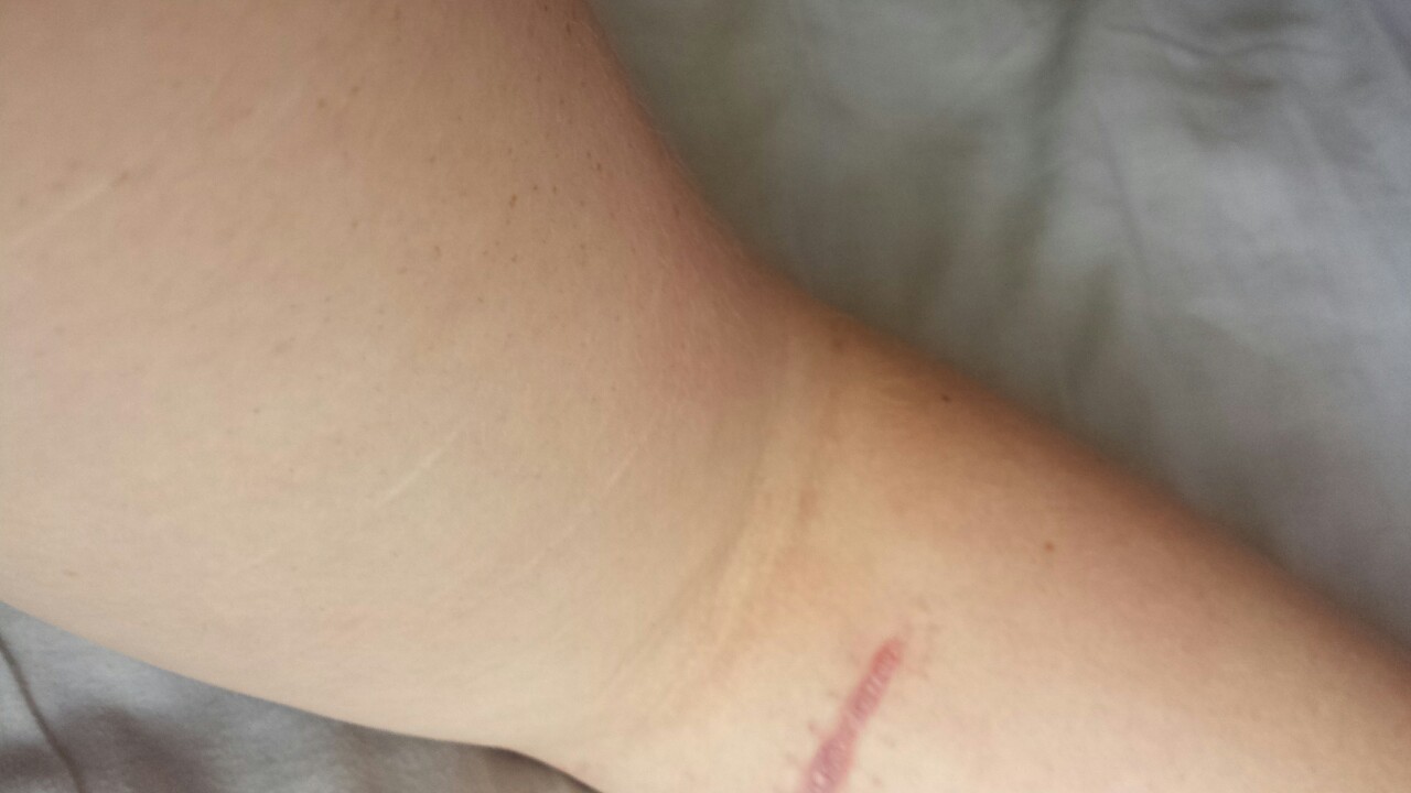 daddyismymrj:  Bits of me I need to learn to love: -My scars. -Stretch marks. -My