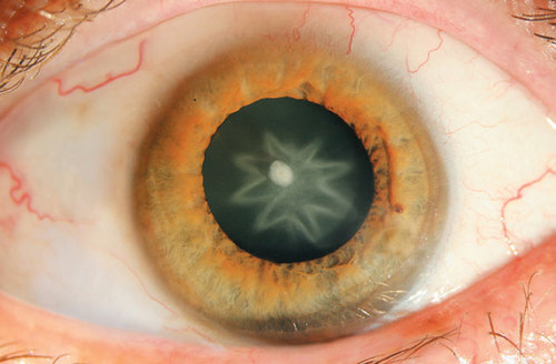 coma-kidd:Star-shaped cataract in the eye of a 55-year old man, resulting from a punch.