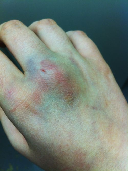 kisskissmollys-lips:Bruised hands collection