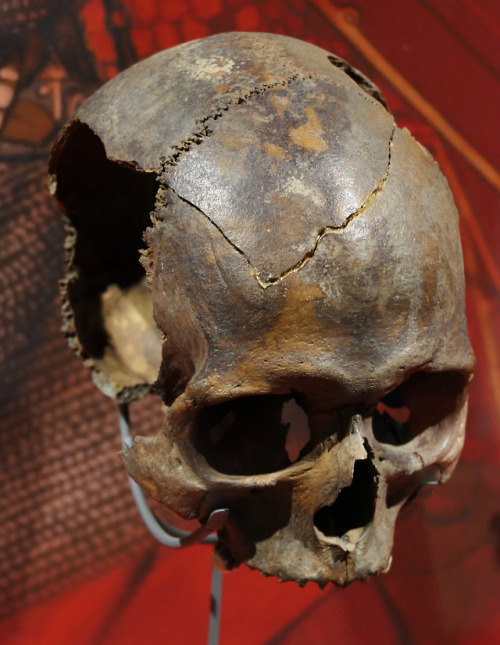 Man’s Skull found at Vindolanda Roman Fort, near Hadrian’s Wall, Northumbria, 24.2.18.This unfortuna