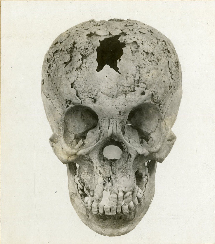 Syphilitic skull. Tertiary syphilis, untreated for almost 27 years. 1910. From National