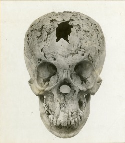 Syphilitic skull. Tertiary syphilis, untreated