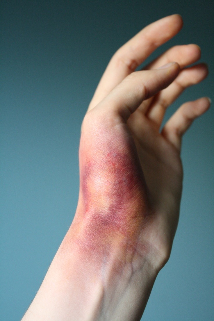 kisskissmollys-lips:Bruised hands collection