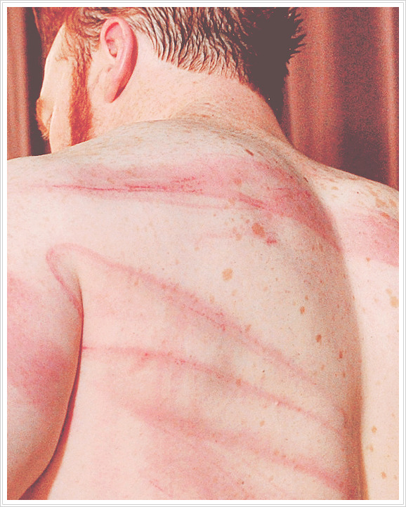 w4de-barrett:  Sheamus getting treated for his welts.  OUCH!!!