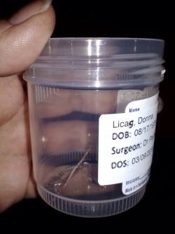 candiedmoon:gamegeek2589:  gamegeek2589:  meggoooo:mrsverges:So these are the poisonous coils I had taken out of me Monday, along with my fulopian tubes. These are called Essure permanent birth control coils. I had them placed 6weeks after having SAV