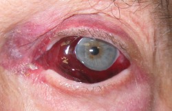 eyedefects:  Elderly patient presents with atraumatic monocular subconjunctival haemorrhage 