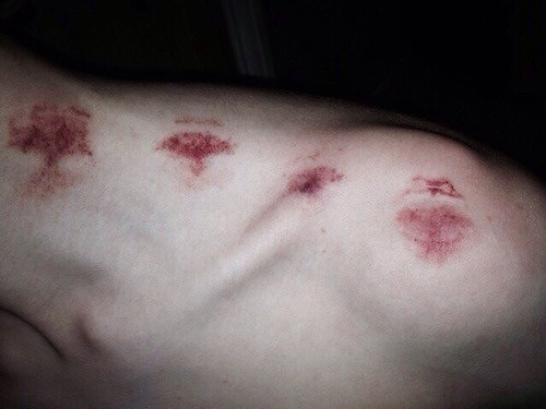 pale-0rgasm:  Bite marks on We Heart It.  Playing soccer?
