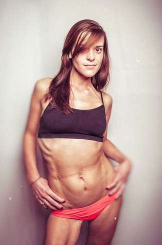 talapishka:    A Photographer Started A Photo Project To Show That Women With Cystic