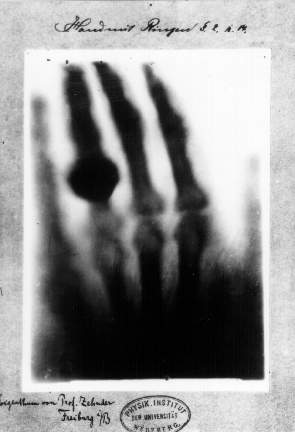 Hand mit Ringen (Hand with Ring),The first medical X-ray, circa 1895. Taken by X-ray inventor Wilhel