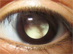 logija:  leukocoria (abnormal white pupillary reflection) 