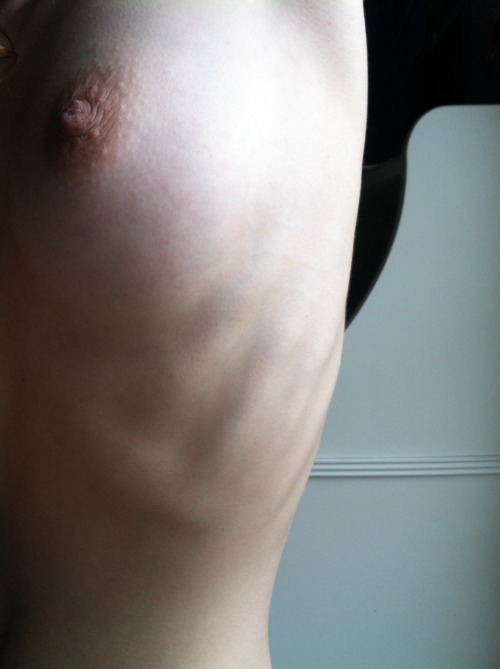 thepureskin:  naked-yogi:  Because yes, stretch marks are beautiful.    SEE MORE OF NAKED-YOGI HERE   