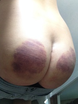 misspandapants:  My butt after this years Fusion. I had such a good time, delving much deeper than a photo of a bruised butt could convey but overall I have so many deep thoughts I think I couldn’t possibly type out… so, spankings, caning and kicking,