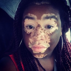 elvagilante:  laninjapanama:#vitiligo #vitiligobeauty  Yas, bDem eyesss.