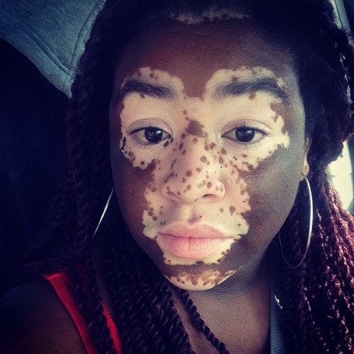 laninjapanama:#vitiligo #vitiligobeauty