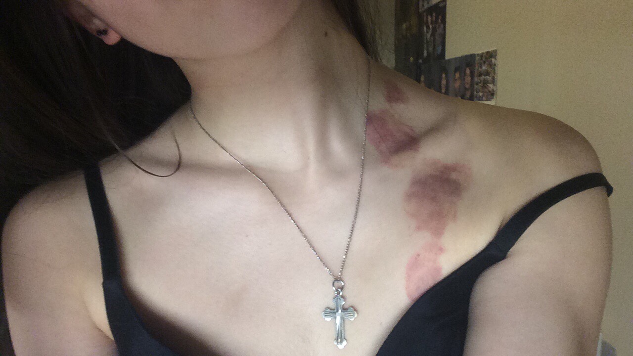 bite me