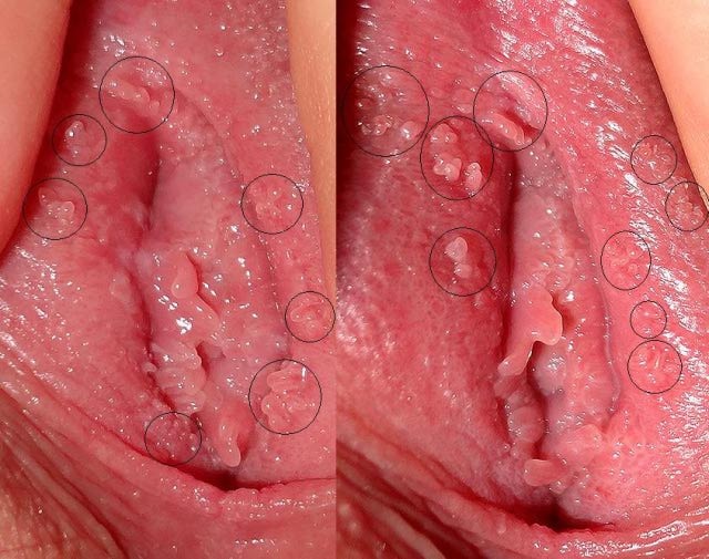 Genital herpes in women vagina