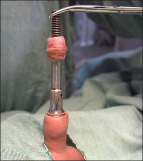 studsnpuds:  Circumcision using a Winkelmann Clamp. They’re made in adult sizes