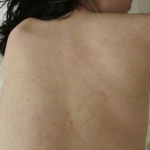 koto-bdsm: The scars have been 15 days since last time.