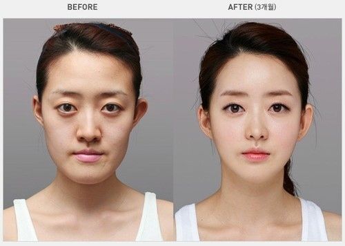 korean plastic surgery before and after jaw