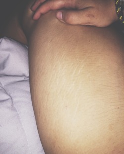 labellejeunefillesansmercii:  Turns out the reason I’ve been noticing more/more visible stretch marks has the to do with my illness. And here I was trying to figure out how losing weight gave me more stretch marks than gaining it ever did. Lucky for