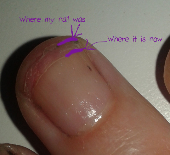 Don’t click the “Read More” link if you’re easily squicked by injuries to fingernails.You know how your mother always told you not to bite your nails?? THIS IS WHY!