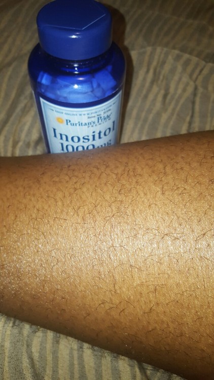 omgpcos:Almost 3 weeks of leg hair growth thanks to inositol. Before i ever knew what this product w