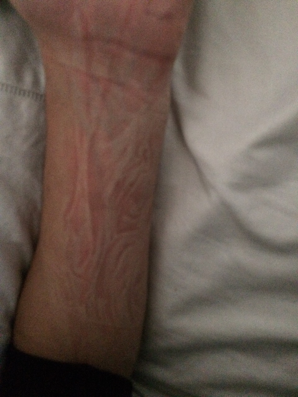 scumdeath:  I slept on my arm