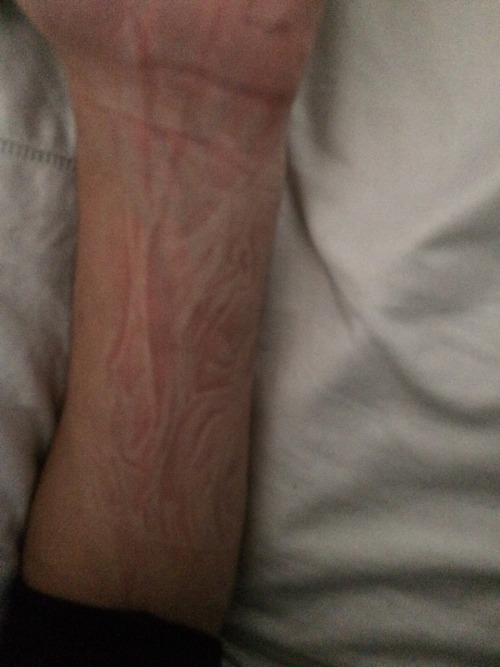 scumdeath:I slept on my arm