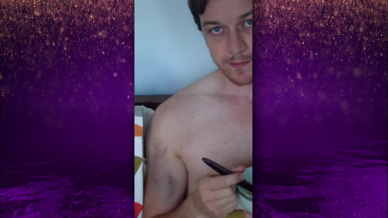 mcavoyclub:  How James McAvoy got a bruise for playing the punching game with Hugh