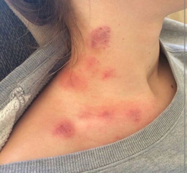 Like looks red hickey neck mark on How To