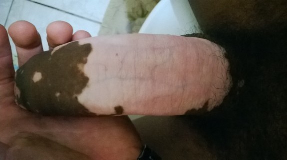 jamaicangayboy:  Jamaican vitiligo straight boy .