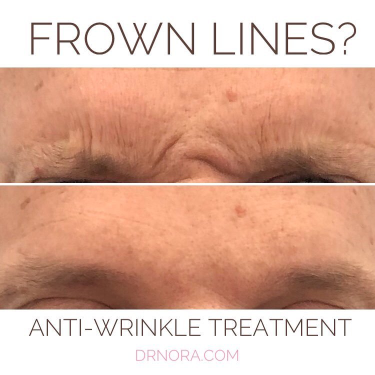 Great way to end the week!This chap has regular anti-wrinkle treatment to keep those frown lines at bay and it really pays off!
His lines have softened and his frown is no more.
Anti-wrinkle therapy is a quick and easy way to minimise signs of ageing...