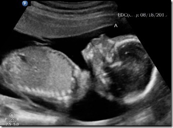 kryptonarry:  narryisbaeee:  kryptonarry:Fetus Direction Is it crazy I know which one is which  Yes because those are random ultrasound pictures from Google.