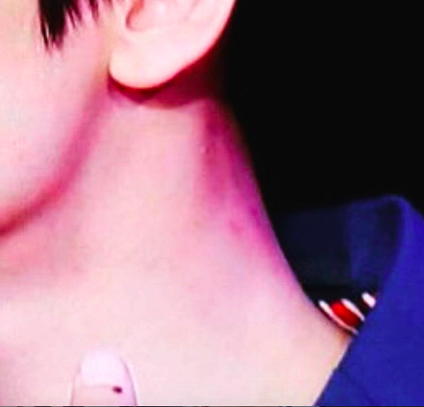 Kiss mark neck Best Kissing