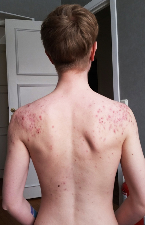 sveriqueer: a little over 10 months on T face acne? not too bad, have had much worse shoulder (&