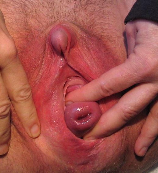 biggergapes-betterbabes:  descensus uteri, prolapsus uteri  Wow! Amazing clit, amazing