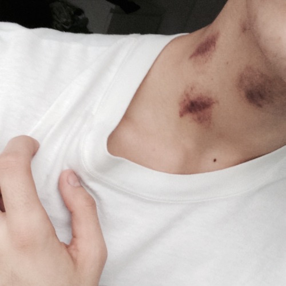 With hickeys guys How to