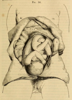 nemfrog:  Fig. 30. Advanced state of pregnancy. Manuel des accouchements et des maladies des femmes grosses et accouchées. 1846.