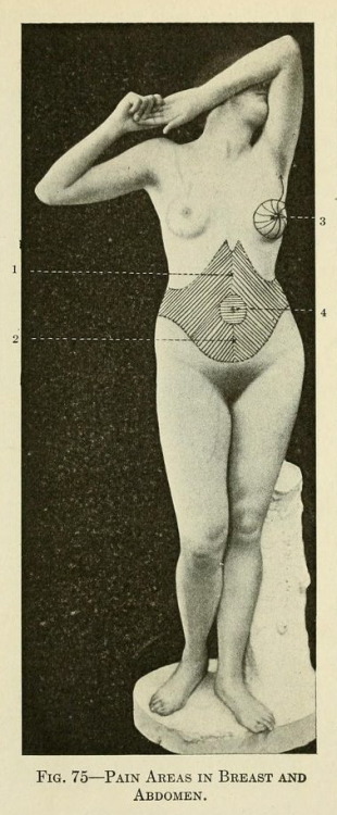 nemfrog:Fig. 75. Pain areas. Pain, its origin, conduction, perception and diagnostic significance.