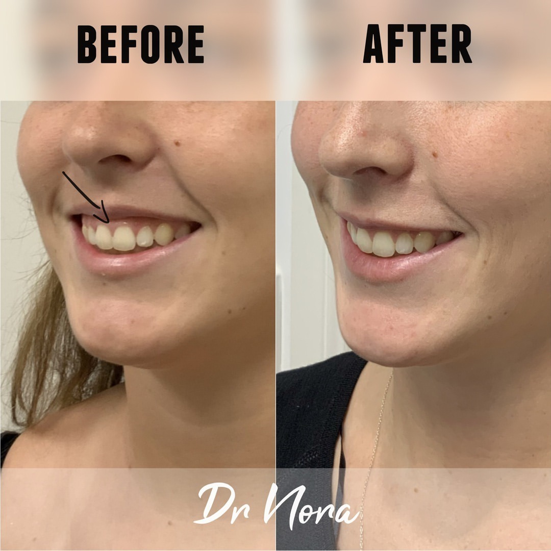 Anti-wrinkle treatment of a gummy smile ðŸ˜ƒAnti-wrinkle therapy can be used to reduce the appearance of a gummy smile. Treatment time is 15 minutes, optimal results are seen at 2 weeks and lasts up to 3-5 months.
If you have any questions or would like...