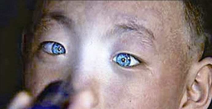 sixpenceee:  sixpenceee:  Nong Youhui, a blue-eyed boy in China, stunned doctors