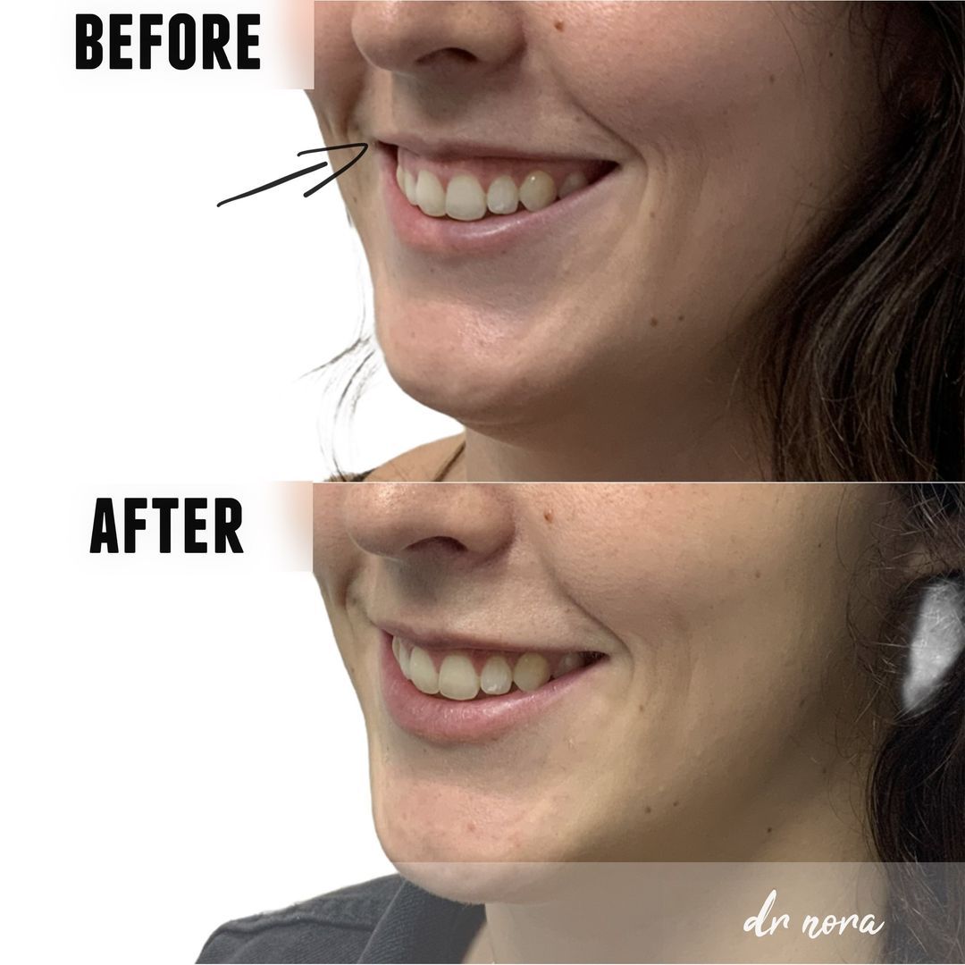 Anti-wrinkle treatment of a gummy smile πAnti-wrinkle therapy can be used to reduce the appearance of a gummy smile. Treatment time is 15 minutes, optimal results are seen at 2 weeks and lasts up to 3-5 months.
If you have any questions or would like...