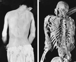 ghostly-haze:  Fibrodysplasia ossificans progressiva (FOP), sometimes referred to as Stone Man Syndrome, is an extremely rare disease of the connective tissue. A mutation of the body’s repair mechanism causes fibrous tissue (including muscle, tendon,
