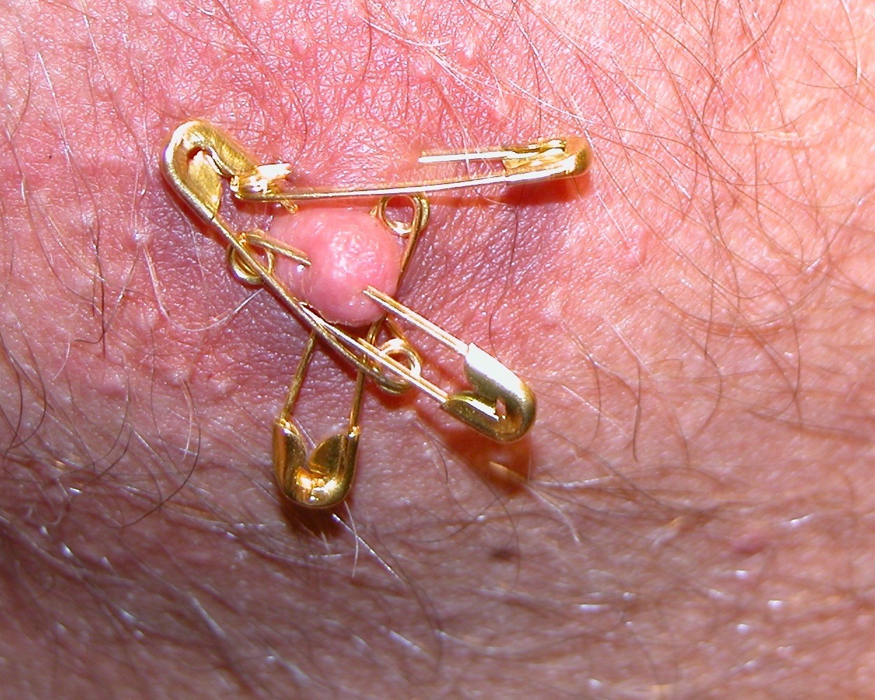 my nipple pinned