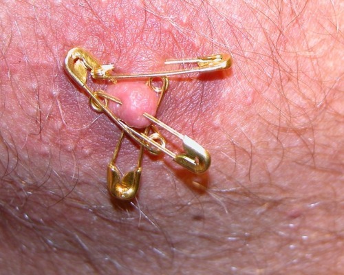 my nipple pinned