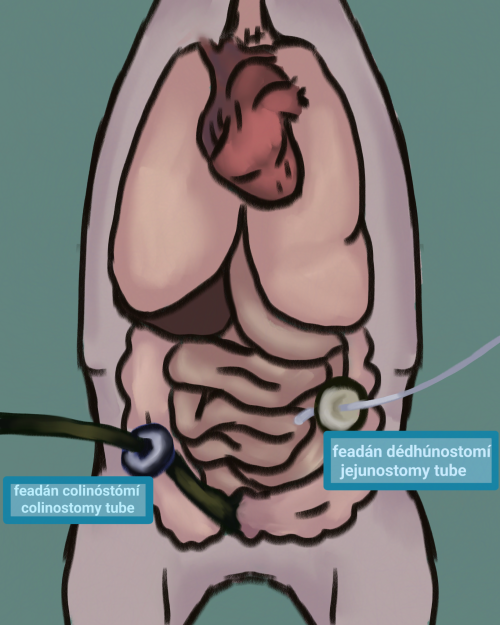 gaeilge: learaid de an feadan dudheostomi agus an feadan colinosami sa steag beag agus mor
english: a diagram of the jujeostomy and the colonostomy tubes in the small and large intestine
