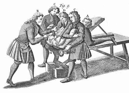 How to Remove a Kidney Stone in the Middle Ages,During the Middle Ages up to around 19th century, ad