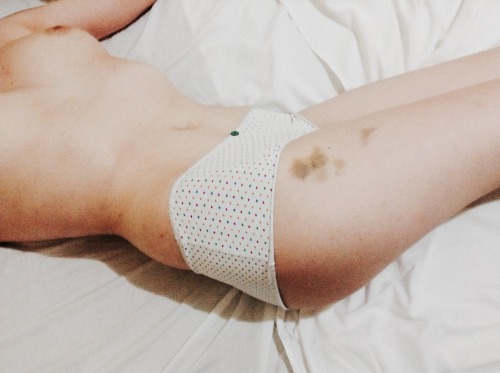 ourholestory:  bruises after sex :) - 22 
